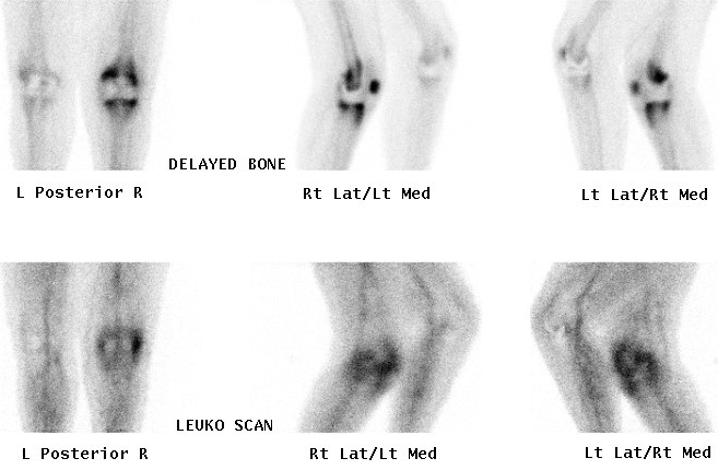 Bone scan and Leucocyte Scan Infected TKR